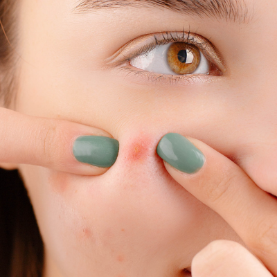 Quelles solutions naturelles contre l'acné ?