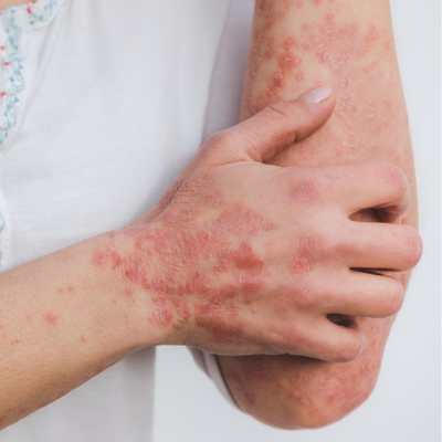 psoriasis